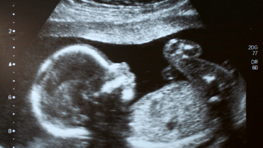 baby ultrasound picture