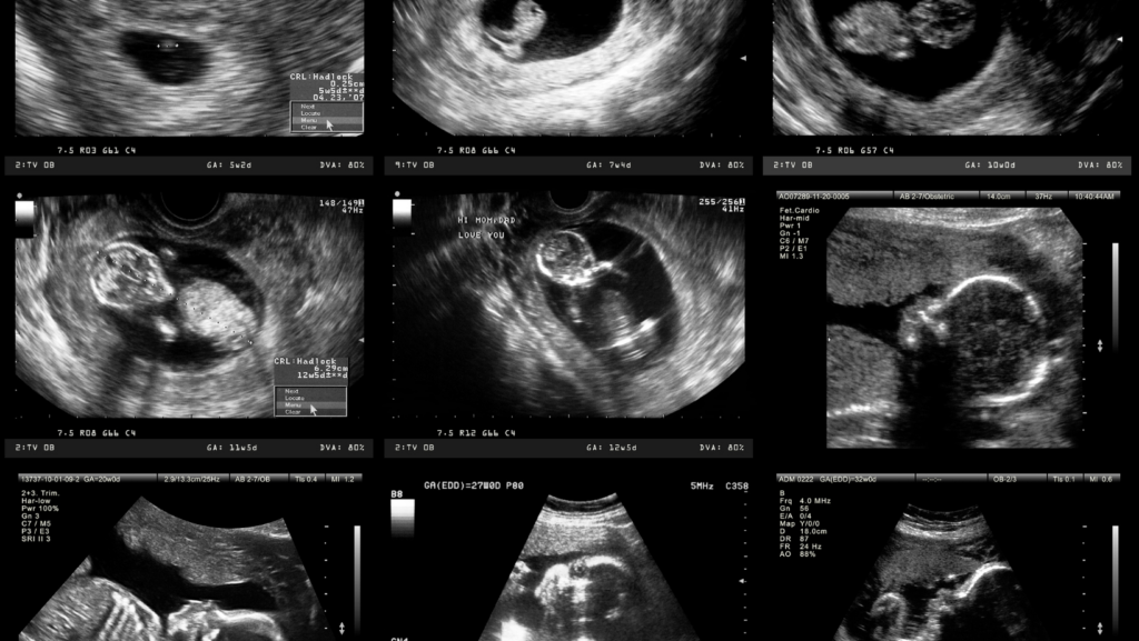 ultrasound pictures